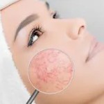 Couperose: symptomer, behandlinger, skjønnhetsprodukter